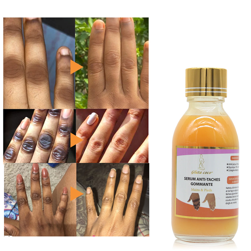 5D Gluta Anti-spot Hand & Foot Serum for Dark Skin Whitening